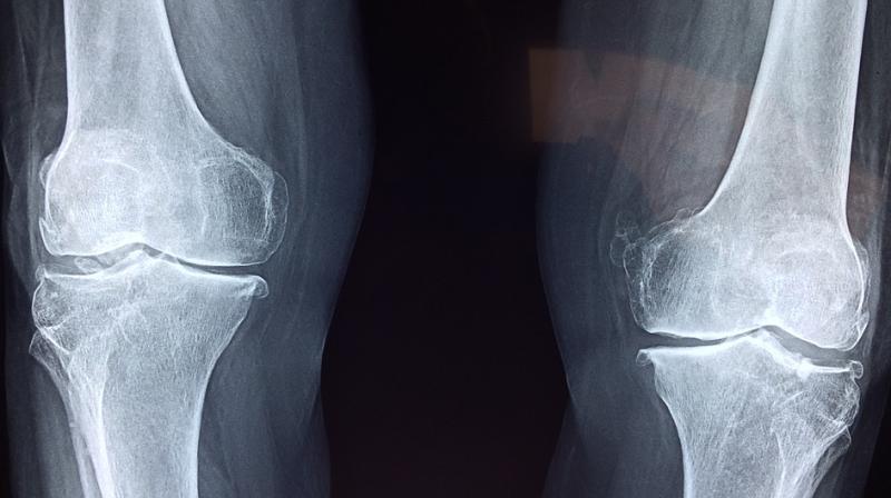 Rheumatoid arthritis (RA) is a long-term disease that causes inflammation and deformity of the joints. (Photo: Pixabay) Rheumatoid arthritis (RA) is a long-term disease that causes inflammation and deformity of the joints. (Photo: Pixabay)