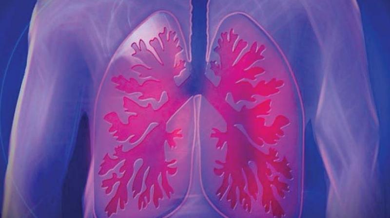 Acute bronchiolitis is highly infectious and usually spreads from one child to another. (Representional Image) Acute bronchiolitis is highly infectious and usually spreads from one child to another. (Representional Image)