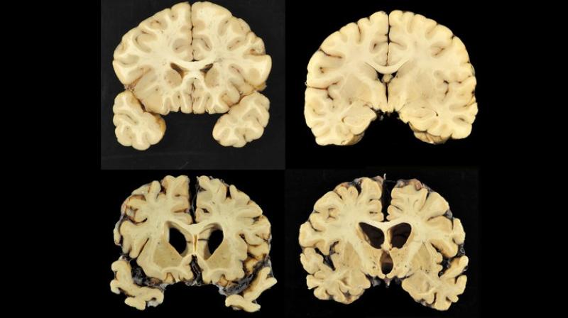 This combination of photos provided by Boston University shows sections from a normal brain, top, and from the brain of former University of Texas football player Greg Ploetz, bottom, in stage IV of chronic traumatic encephalopathy. (Photo: AP) This combination of photos provided by Boston University shows sections from a normal brain, top, and from the brain of former University of Texas football player Greg Ploetz, bottom, in stage IV of chronic traumatic encephalopathy. (Photo: AP)