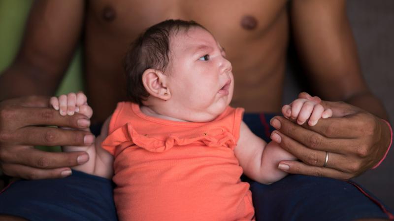 Microcephaly is not the most common congenital defect from the Zika virus. (Photo: AP) Microcephaly is not the most common congenital defect from the Zika virus. (Photo: AP)
