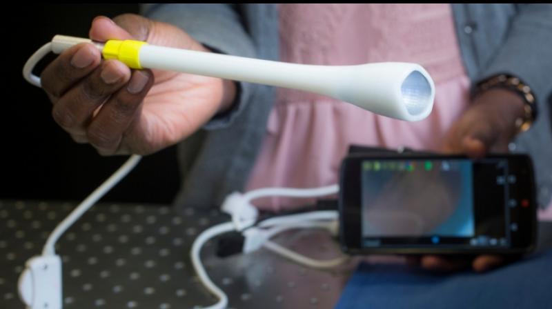 A prototype of the speculum-free “pocket colposcope” being developed by Duke University produces images on a smart phone or laptop and can make cervical cancer screening more accessible to women living in low-resource areas. (Photo: Duke University) A prototype of the speculum-free “pocket colposcope” being developed by Duke University produces images on a smart phone or laptop and can make cervical cancer screening more accessible to women living in low-resource areas. (Photo: Duke University)