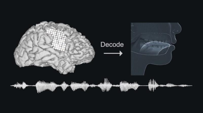 Scientists at the University of California, San Francisco, implanted electrodes into the brains of volunteers and decoded signals in cerebral speech centres to guide a computer-simulated version of their vocal tract - lips, jaw, tongue and larynx - to generate speech through a synthesizer. Scientists at the University of California, San Francisco, implanted electrodes into the brains of volunteers and decoded signals in cerebral speech centres to guide a computer-simulated version of their vocal tract - lips, jaw, tongue and larynx - to generate speech through a synthesizer.