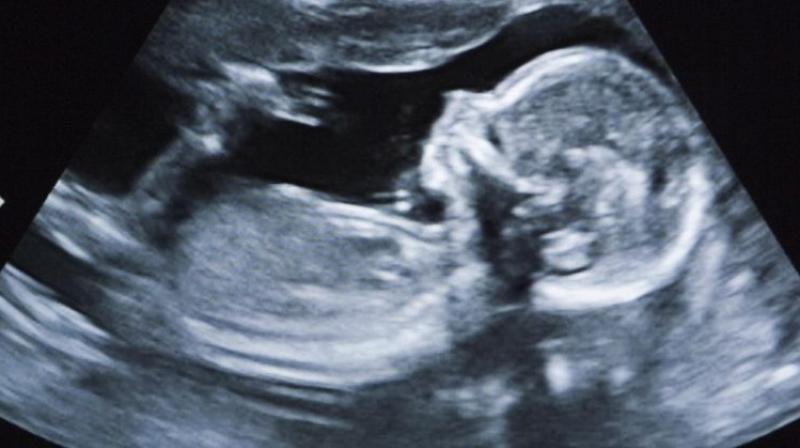Since sonography wasn't done, neither the woman nor doctors knew that the baby was still there (Photo: AFP) Since sonography wasn't done, neither the woman nor doctors knew that the baby was still there (Photo: AFP)