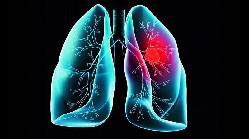 Here are 6 Early Signs of Lung Cancer