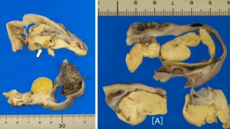 The tumour was about 10 centimetres wide and held a mat of greasy hair and a brain-like structure that was covered by skull-like bone material. (Credit: GeoBeats News/ YouTube) The tumour was about 10 centimetres wide and held a mat of greasy hair and a brain-like structure that was covered by skull-like bone material. (Credit: GeoBeats News/ YouTube)