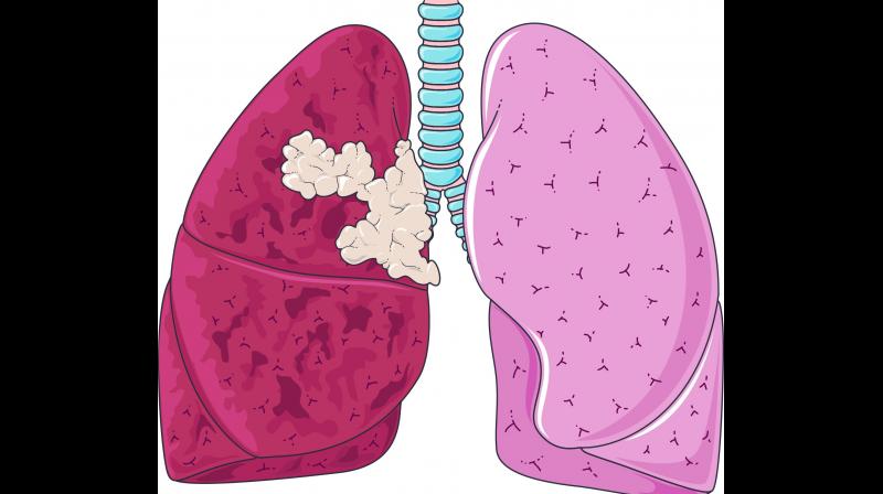 Nowadays, women are also getting diagnosed with the lung cancer. One of the main reason is passive smoking. Nowadays, women are also getting diagnosed with the lung cancer. One of the main reason is passive smoking.