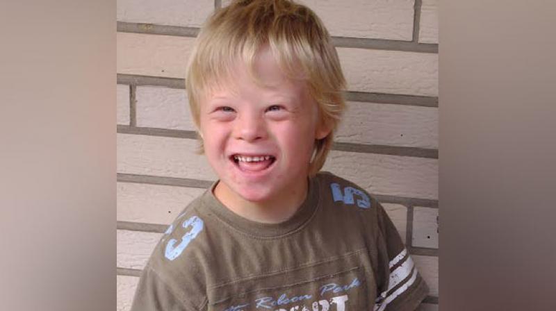 A subsequent clinical visit with a different physician confirmed all suspected cases of arthropathy of Down syndrome. (Photo: ANI) A subsequent clinical visit with a different physician confirmed all suspected cases of arthropathy of Down syndrome. (Photo: ANI)