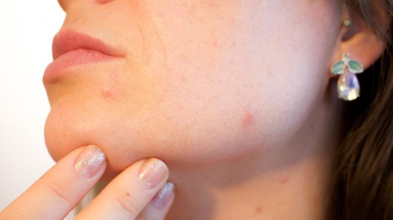 New vaccine could soon treat acne. (Photo: Pixabay) New vaccine could soon treat acne. (Photo: Pixabay)