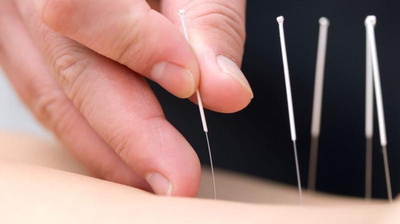 Researchers tested the traditional Chinese needle-piercing remedy in a trial involving nearly 150 babies (Photo: AFP) Researchers tested the traditional Chinese needle-piercing remedy in a trial involving nearly 150 babies (Photo: AFP)