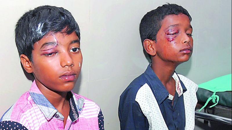 Ten-year-old Ramesh and Shiva wait at the Sarojini Devi Eye Hos-pital on Monday. (Photo: DC) Ten-year-old Ramesh and Shiva wait at the Sarojini Devi Eye Hos-pital on Monday. (Photo: DC)