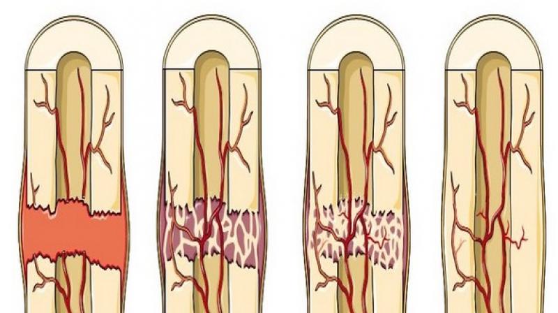 When you break a bone, your body sends signals through the bloodstream to recruit cells to fix it. (Photo: ANI) When you break a bone, your body sends signals through the bloodstream to recruit cells to fix it. (Photo: ANI)