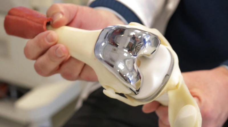 All had metal-containing joint replacement components and none had signs of infection, inflammation (Photo: AP) All had metal-containing joint replacement components and none had signs of infection, inflammation (Photo: AP)