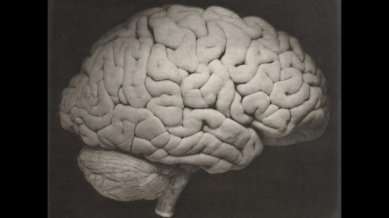 This 1885 photo shows a side view of a human brain. (Oscar G. Mason/J.C. Dalton/Philadelphia, Lea Brothers & Co. via AP) This 1885 photo shows a side view of a human brain. (Oscar G. Mason/J.C. Dalton/Philadelphia, Lea Brothers & Co. via AP)
