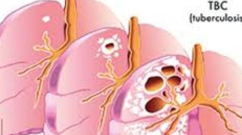 TB cases reported in the state last year elicited a shocking revelation of about 45,000 cases in the state of Telangana. (Representational Image) TB cases reported in the state last year elicited a shocking revelation of about 45,000 cases in the state of Telangana. (Representational Image)