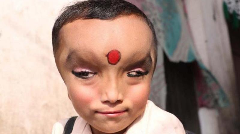Pranshu has a medical condition that caused him to be born with an enlarged forehead and narrow eyes. (Credit: YouTube) Pranshu has a medical condition that caused him to be born with an enlarged forehead and narrow eyes. (Credit: YouTube)
