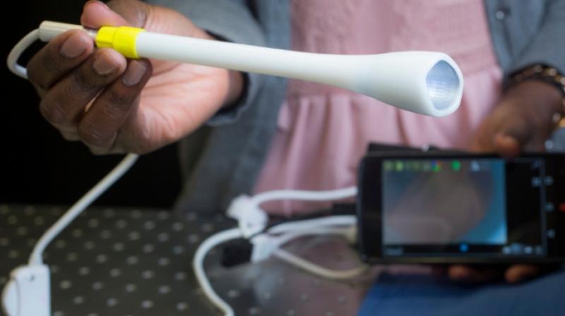 A prototype of the speculum-free “pocket colposcope” being developed by Duke University produces images on a smart phone or laptop and can make cervical cancer screening more accessible to women living in low-resource areas. (Photo: Facebook / Duke University) A prototype of the speculum-free “pocket colposcope” being developed by Duke University produces images on a smart phone or laptop and can make cervical cancer screening more accessible to women living in low-resource areas. (Photo: Facebook / Duke University)