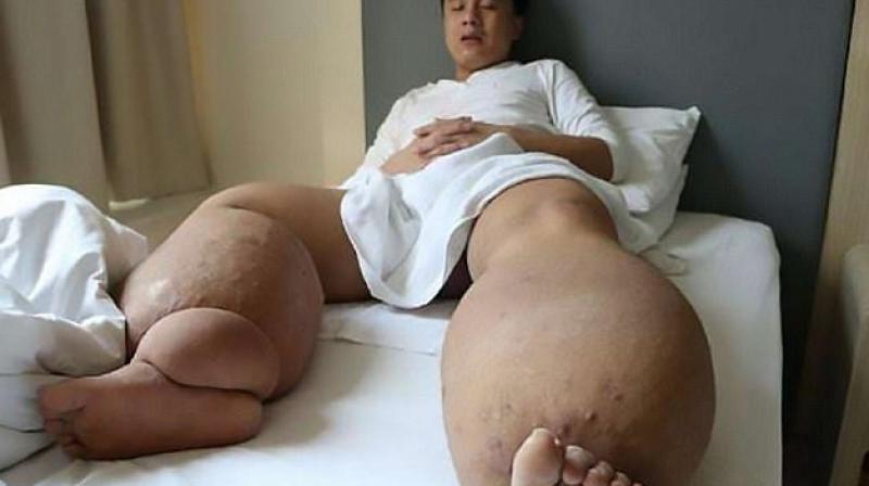 The disease has also left him unable to urinate (Photo: YouTube) The disease has also left him unable to urinate (Photo: YouTube)