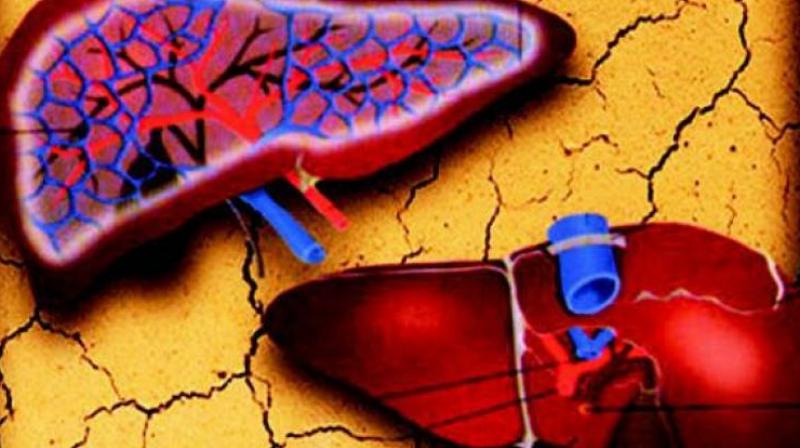 While alcohol is stated to be the major reason for cirrhosis, the rise in non-alcoholic fatty liver is also one of the major reasons for the growing incidence of the disease. While alcohol is stated to be the major reason for cirrhosis, the rise in non-alcoholic fatty liver is also one of the major reasons for the growing incidence of the disease.