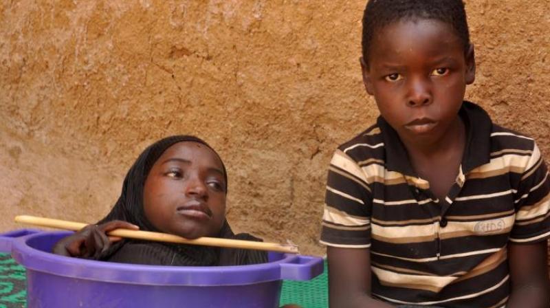 Rahma Haruna, 19, (left) not only has to endure chronic pain but also spends her waking hours in a plastic bowl, which her family carry her around in. (Credit: YouTube) Rahma Haruna, 19, (left) not only has to endure chronic pain but also spends her waking hours in a plastic bowl, which her family carry her around in. (Credit: YouTube)