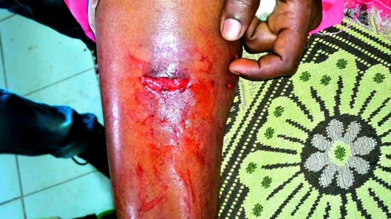 Victim of stray dog attacks in various parts of the city show their wounds. (Photo: DC) Victim of stray dog attacks in various parts of the city show their wounds. (Photo: DC)
