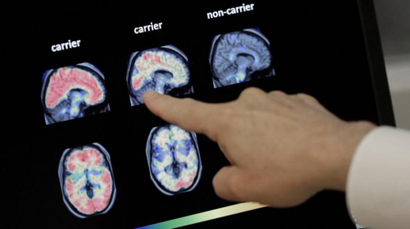 Biogen said it would offer aducanumab now to patients enrolled in these and earlier studies of it. (Photo: AP) Biogen said it would offer aducanumab now to patients enrolled in these and earlier studies of it. (Photo: AP)