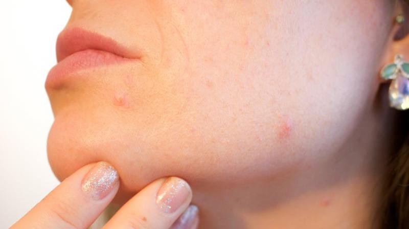 Acne includes whiteheads, blackheads, pimples, cysts and nodules that affect the face, shoulders, back, chest and upper arms. Acne includes whiteheads, blackheads, pimples, cysts and nodules that affect the face, shoulders, back, chest and upper arms.