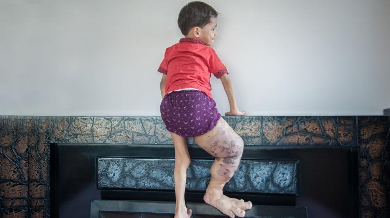 Akshaj Khandelwal from Dwarka in Delhi was diagnosed with a genetic disorder called Klippel-Trenaunay Syndrome (KTS). (Credit: YouTube) Akshaj Khandelwal from Dwarka in Delhi was diagnosed with a genetic disorder called Klippel-Trenaunay Syndrome (KTS). (Credit: YouTube)