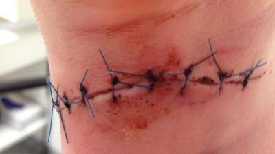 The invention can also minimise risk of infections as human tissue won’t be pierced (Photo: Pixabay)