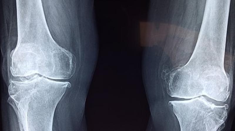 The quality of implant plays a critical role in success of surgery. (Photo: Representational/Pixabay) The quality of implant plays a critical role in success of surgery. (Photo: Representational/Pixabay)
