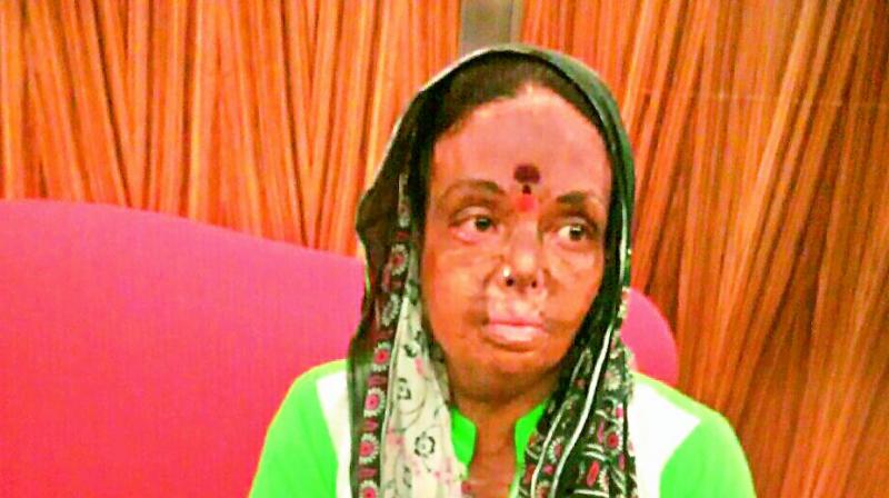 D. Pushpa who has been undergoing immense suffering since the fire accident. D. Pushpa who has been undergoing immense suffering since the fire accident.