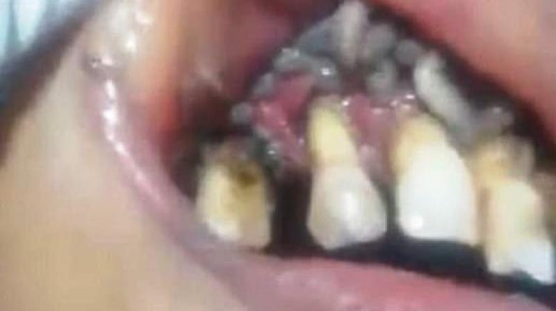 The clip shows bizarre consequences of poor oral hygiene (Photo: YouTube) The clip shows bizarre consequences of poor oral hygiene (Photo: YouTube)