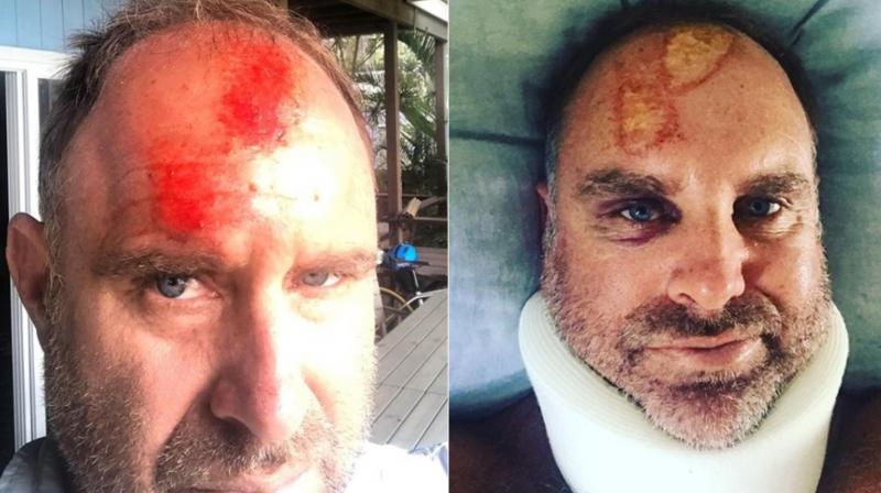 Matthew Hayden fractured his spine near the base of his neck, tore several ligaments and hurt his forehead after being dumped into a sandbank while surfing with his son Josh off North Stradbroke Island on Friday. (Photo: Instagram / Matthew Hayden) Matthew Hayden fractured his spine near the base of his neck, tore several ligaments and hurt his forehead after being dumped into a sandbank while surfing with his son Josh off North Stradbroke Island on Friday. (Photo: Instagram / Matthew Hayden)