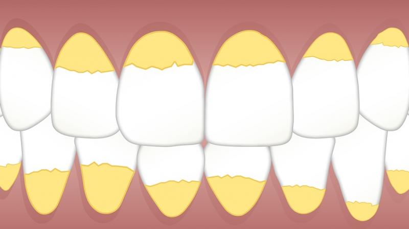 New study links poor oral health to high blood pressure. (Photo: Pixabay) New study links poor oral health to high blood pressure. (Photo: Pixabay)