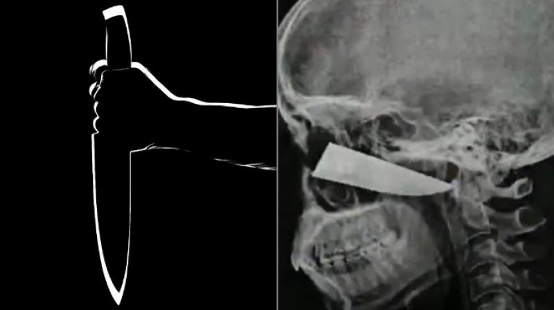 No blood vessels were damaged as the blade was surgically removed (Photo: YouTube/Pixabay) No blood vessels were damaged as the blade was surgically removed (Photo: YouTube/Pixabay)