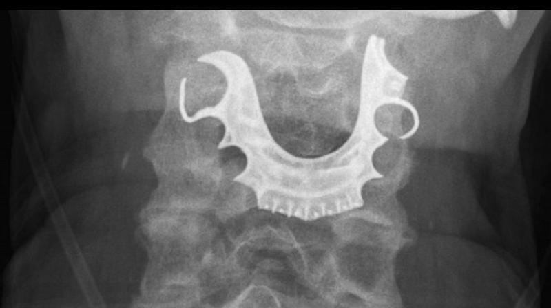 This is the story of a 72-year-old retired electrician in Britain, who forgot to tell his surgeon that he wore dentures. (Photo: AP) This is the story of a 72-year-old retired electrician in Britain, who forgot to tell his surgeon that he wore dentures. (Photo: AP)