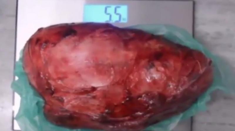 The mass removed measured 31 by 19 cm (Photo: YouTube) The mass removed measured 31 by 19 cm (Photo: YouTube)