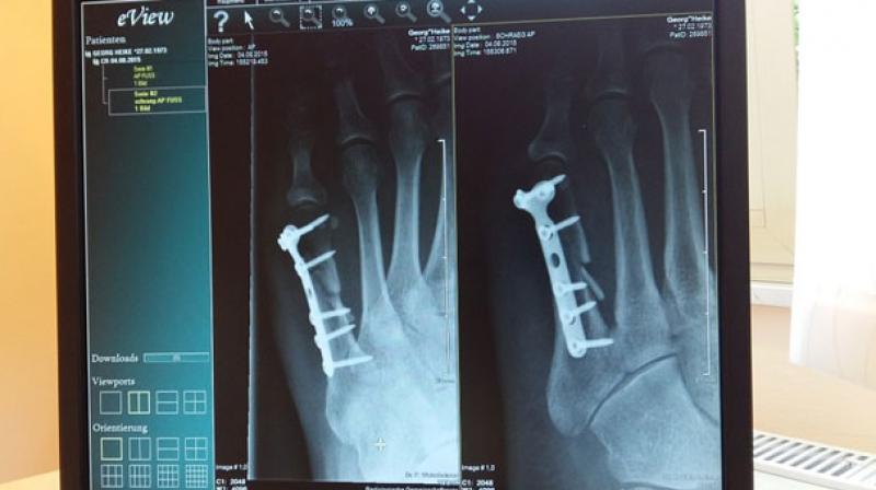Osteoporosis is a progressive condition in which bones become structurally weak and are more likely to fracture or break. (Representational Image) Osteoporosis is a progressive condition in which bones become structurally weak and are more likely to fracture or break. (Representational Image)