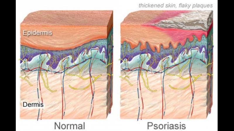 Though not a contagious or life threatening disease, psoriasis, a skin condition, has been found to be the cause of immense mental and physical stress for those affected by it. Though not a contagious or life threatening disease, psoriasis, a skin condition, has been found to be the cause of immense mental and physical stress for those affected by it.