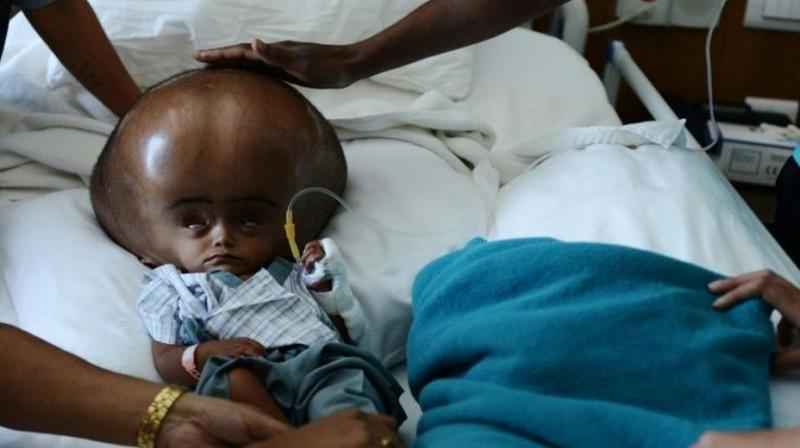 The five-year-old was born with hydrocephalus, a potentially fatal condition that causes cerebrospinal fluid to build up on the brain. (Photo: AFP) The five-year-old was born with hydrocephalus, a potentially fatal condition that causes cerebrospinal fluid to build up on the brain. (Photo: AFP)