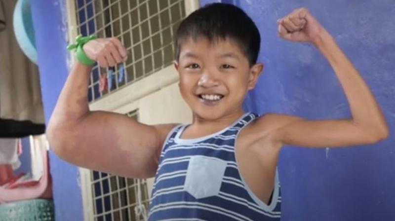 Daniel’s classmates at his school in Rizal, the Philippines, bullied him over the abnormal appearance but he hit back - telling them that he was like cartoon hero Popeye. (Photo: AP) Daniel’s classmates at his school in Rizal, the Philippines, bullied him over the abnormal appearance but he hit back - telling them that he was like cartoon hero Popeye. (Photo: AP)