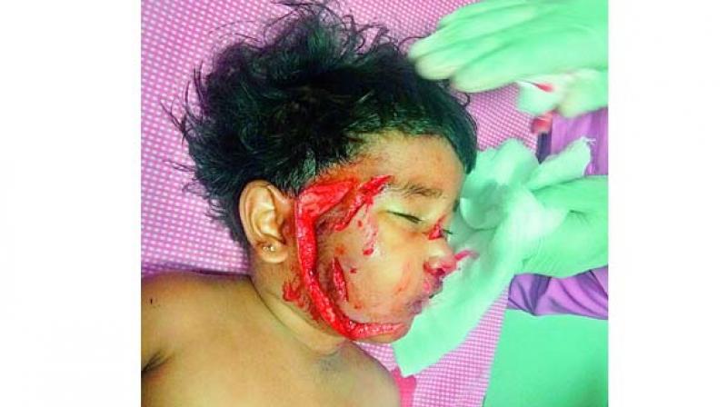 Bhavya lies in a critical condition at Niloufer hospital after a pack of stray dogs attacked her. Bhavya lies in a critical condition at Niloufer hospital after a pack of stray dogs attacked her.