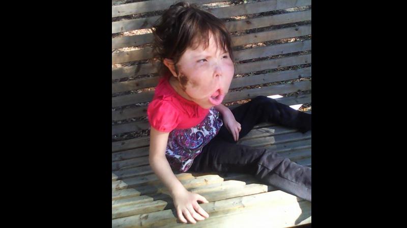 Katie’s condition means that she has to be fed via tube and has already endured numerous surgeries. (Photo: Facebook/ Angie Renfroe) Katie’s condition means that she has to be fed via tube and has already endured numerous surgeries. (Photo: Facebook/ Angie Renfroe)