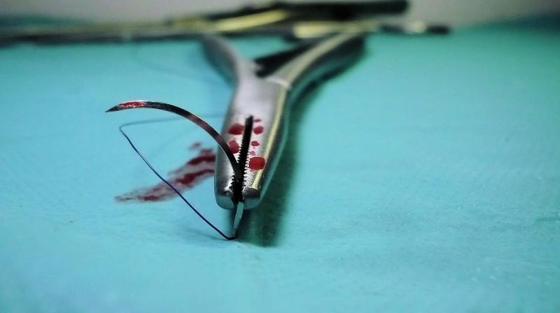 The man underwent surgery in 1998 after a car accident and only recently discovered that doctors had left an unwelcome gift behind when they closed him up. (Photo: Pixabay) The man underwent surgery in 1998 after a car accident and only recently discovered that doctors had left an unwelcome gift behind when they closed him up. (Photo: Pixabay)