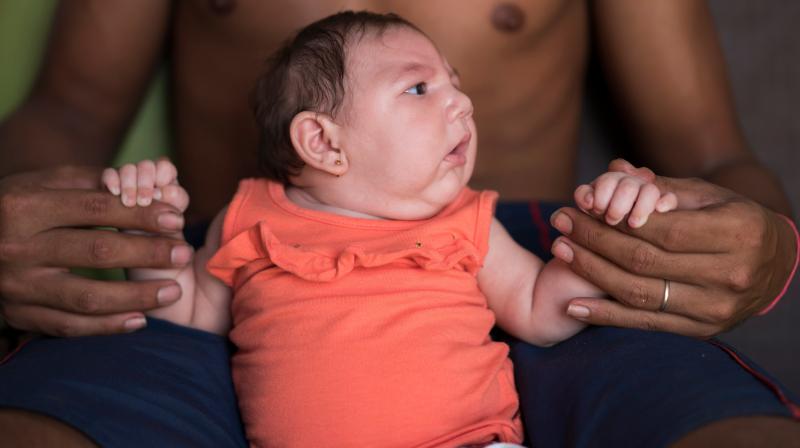 Microcephaly often signifies arrested brain development. (Photo: AP) Microcephaly often signifies arrested brain development. (Photo: AP)