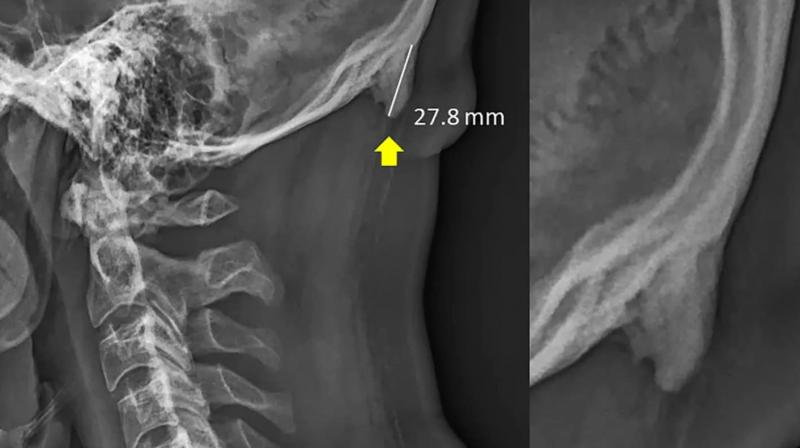 The researchers have noticed horn-like abnormalities protruding out of younger adults skulls. (Photo: Scientific Report) The researchers have noticed horn-like abnormalities protruding out of younger adults skulls. (Photo: Scientific Report)