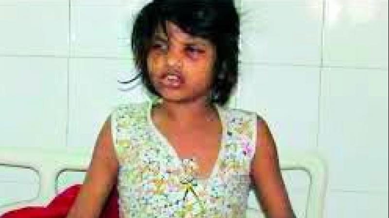 The condition of the girl is slowly improving, doctors said. The condition of the girl is slowly improving, doctors said.