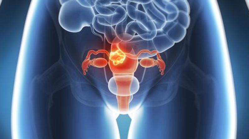 Hysterectomy is performed for a wide range of benign and malignant conditions, such as fibroids, menorrhagia, pelvic pain and gynaecological malignancies. Hysterectomy is performed for a wide range of benign and malignant conditions, such as fibroids, menorrhagia, pelvic pain and gynaecological malignancies.