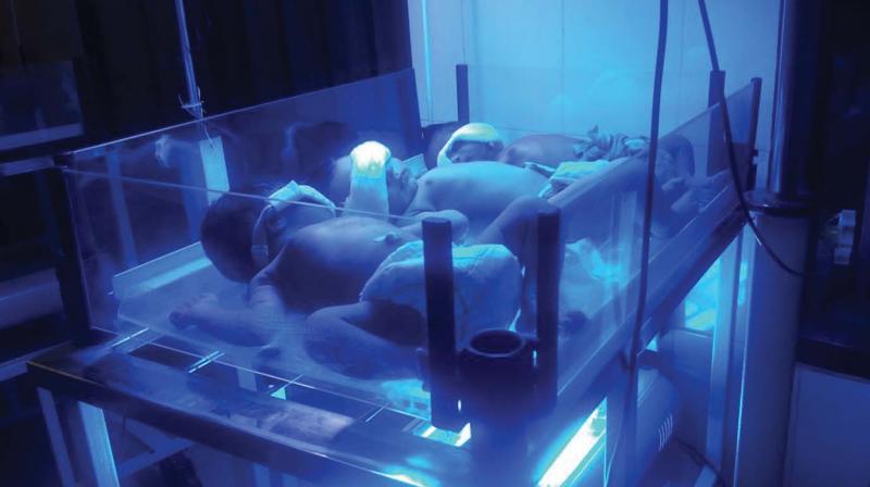 Three children are seen placed together in one phototherapy machine at the unit in the hospital. Three children are seen placed together in one phototherapy machine at the unit in the hospital.