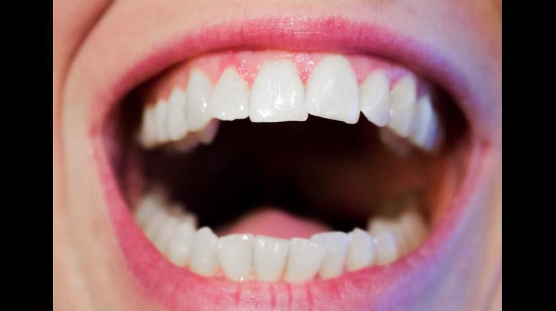 The bacteria, Porphyromonas gingivalis, known as Pg, causes the gum infection chronic periodontitis. (Photo: Pixabay) The bacteria, Porphyromonas gingivalis, known as Pg, causes the gum infection chronic periodontitis. (Photo: Pixabay)