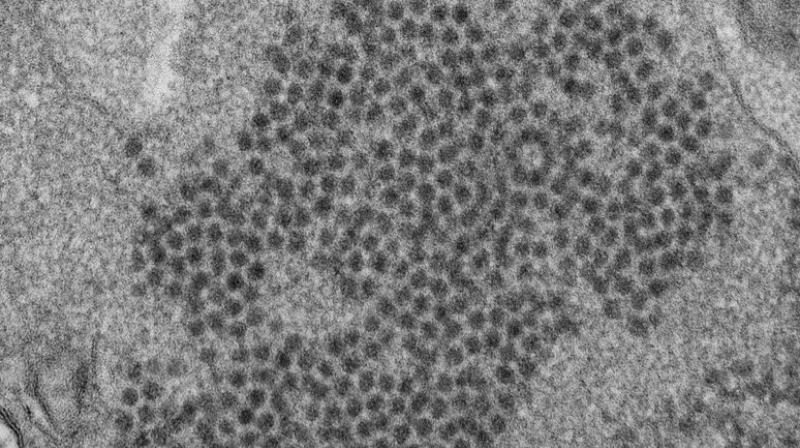 Enteroviruses are hugely common, and doctors don’t know why only a tiny fraction of those infected develop the ailment. (Photo: AP) Enteroviruses are hugely common, and doctors don’t know why only a tiny fraction of those infected develop the ailment. (Photo: AP)